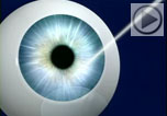 Video introduction of intralase bladeless LASIK