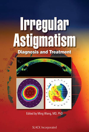 Irregular Astigmatism, by Dr Ming Wang, Nashville Tennessee laser cataract and LASIK Surgeon