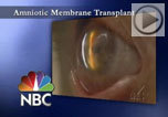 Amniotc Membrane Transplantation