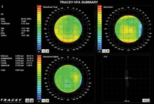 LASIK Surgery using Wavefront Technology