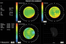 Wavefront LASIK in Tennessee