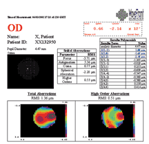 Wavefront Laser LASIK Maping