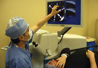 laser cataract