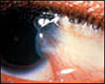 A Pterygium growth