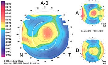 lasik complication