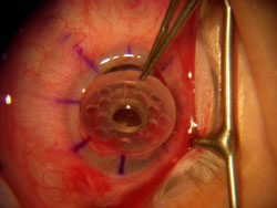 Randy Mathenia's new artificial corneal surgery